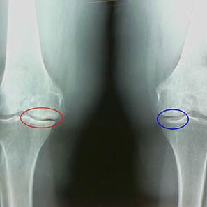Arthroza kolenskega sklepa na radiografu